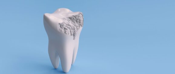 Self-Healing Composite in Dentistry: A Promising Innovation