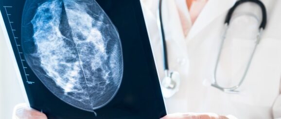 A biomedical compound that has the potential to stop the spread of breast cancer - Innovation Toronto