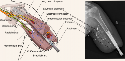 Cutting-Edge Surgical Innovation Enhances Control of Bionic Prosthetics for Amputees - Impact Lab